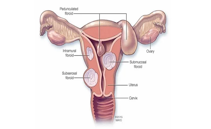 Uterine Fibroid Treatments Uterine Fibroid Treatments