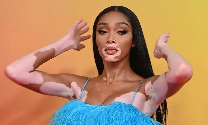 Winnie Harlow Net Worth: Embracing Individuality and Breaking Fashion Norms,Full Name, Age, Notable Works, Net Worth, Controversy, Nationality, Career, Occupation Winnie Harlow