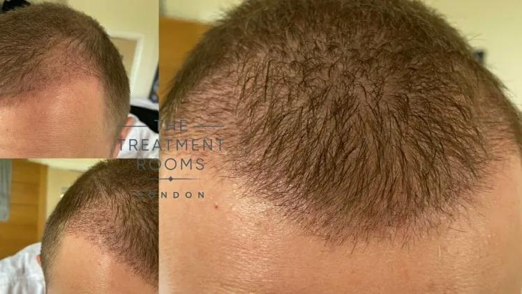 How Quickly Can You Exercise After a Hair Transplant in Turkey? How Quickly Can You Exercise After a Hair Transplant in Turkey