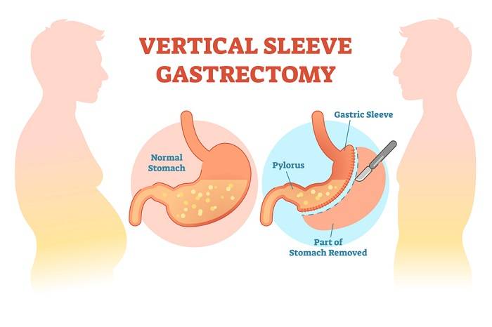 Understanding Gastric Sleeve Surgery