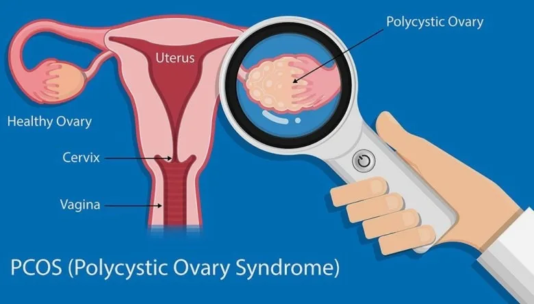 Irregular Periods After Gastric Sleeve: Causes & Management What is PCOS Polycystic Ovary Syndrome