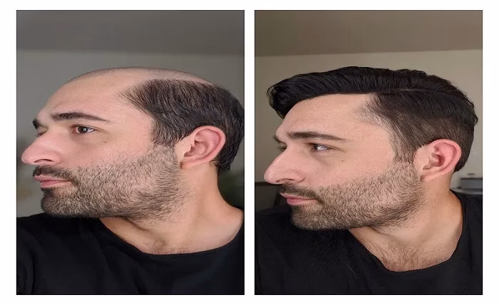 Hair System Myths: Unveiling Fact vs. Fiction Hair System Myths Unveiling Fact vs Fiction 1