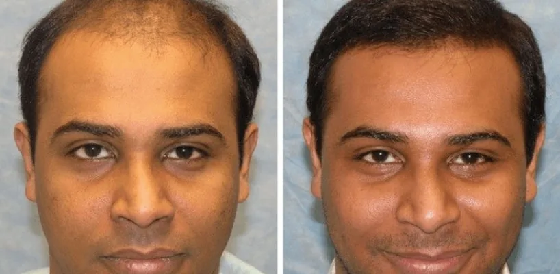 When is the Best Season for a Hair Transplant? When is the Best Season for a Hair Transplant